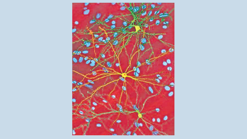 Major cause of dementia discovered