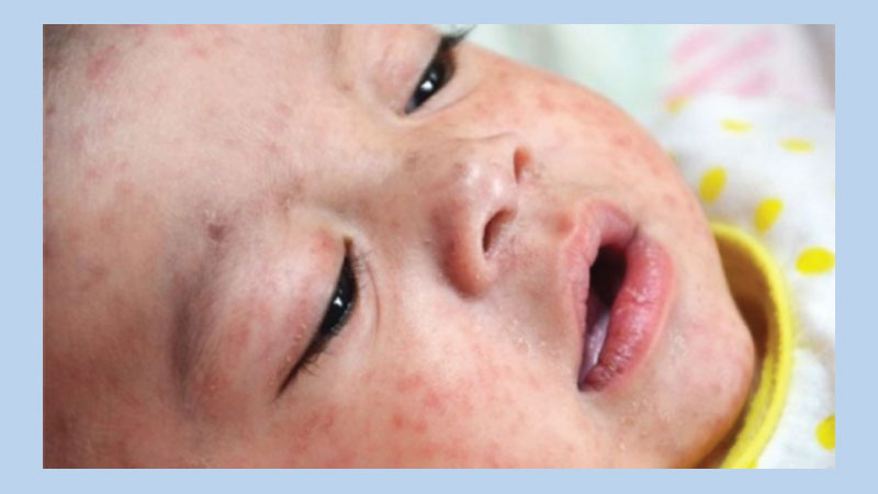 Measles outbreak declared in Philippines