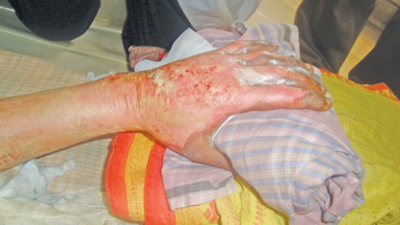 Occupational therapy after burn injury