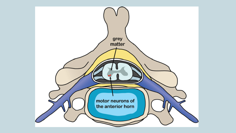 Occupational therapy for motor neuron disease