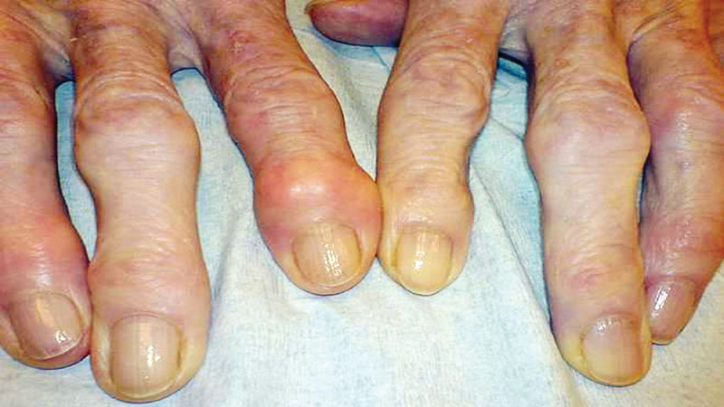 Gout: Causes, Symptoms, Treatment