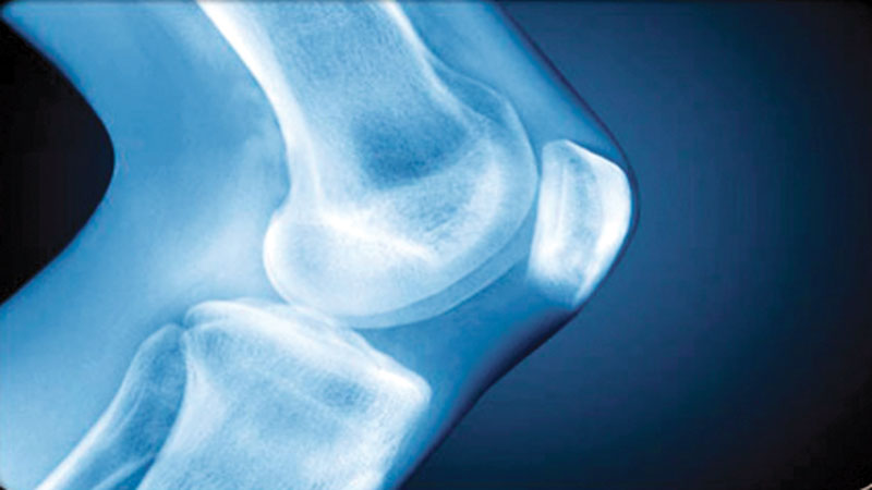 Osteoarthritis