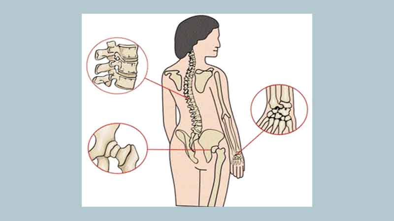 Osteoporosis