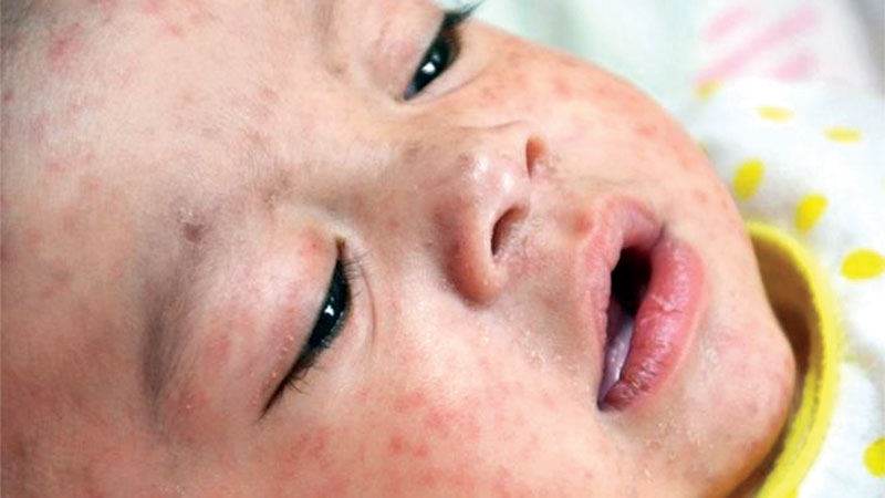 Philippines hit by  measles outbreak