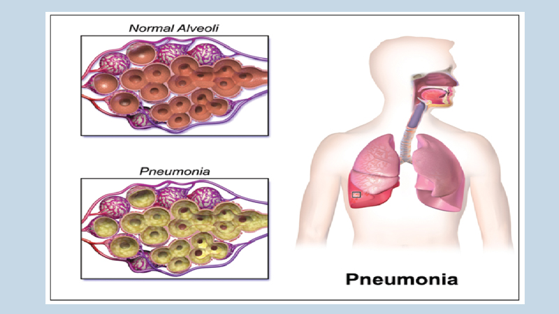 Pneumonia claims the lives of the world’s most vulnerable children