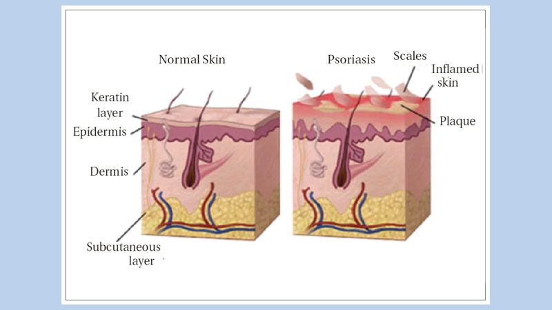 Psoriasis and beyond 