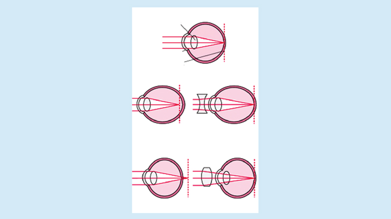 Refractive disorders