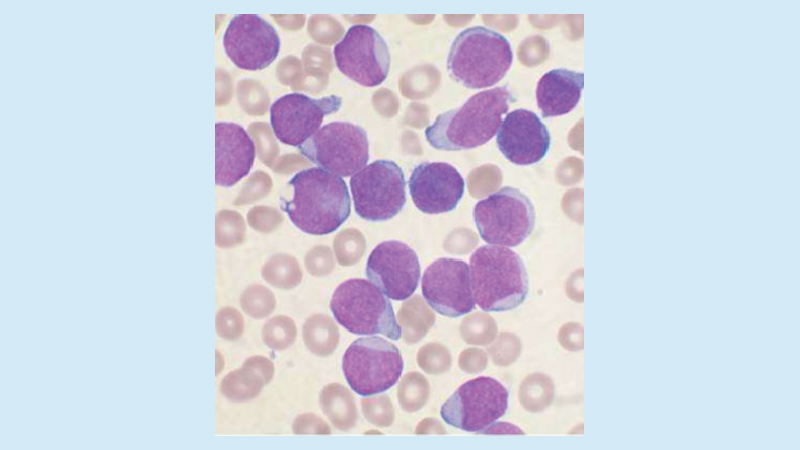 Scientists reveal likely cause of childhood leukaemia