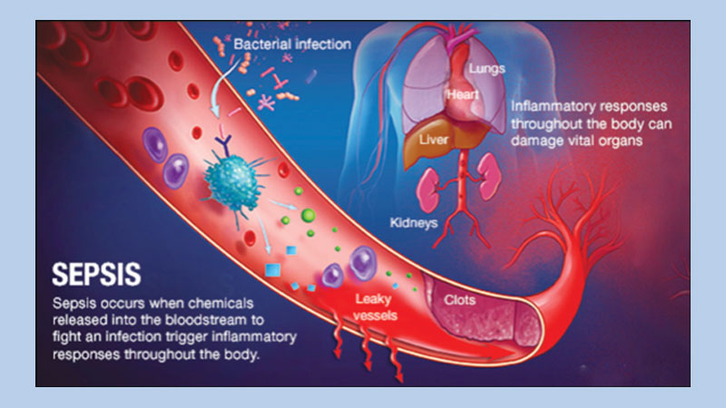 Sepsis: Everything you need to know