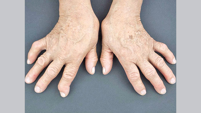 Signs of rheumatoid 
arthritis can show up 
long before diagnosis
