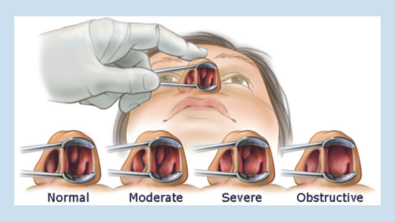 Sinusitis