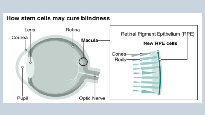Stem cell trial aims to cure blindness