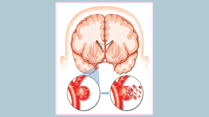 Stroke in Bangladeshi patients