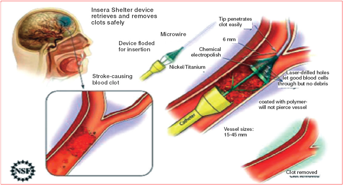 Stroke related questions & answers