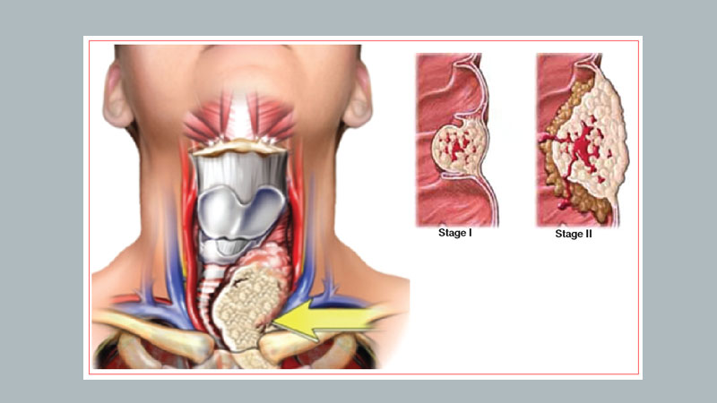 Thyroid cancer: who's at risk?