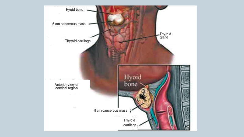 Thyroid cancer: Who's at risk?