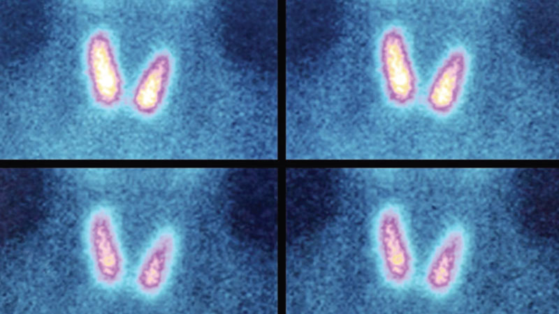 Thyroid cancer: Who's at risk?