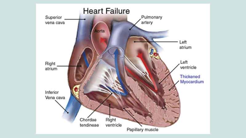 Tips: heart failure
