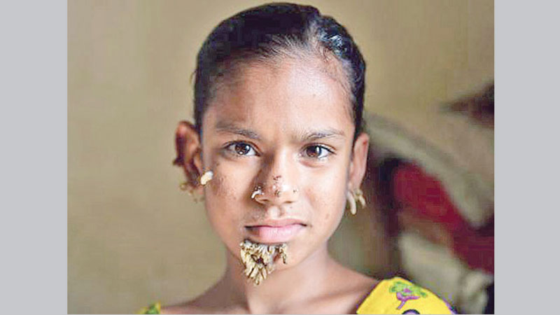 Surgery on ‘tree girl’ successful