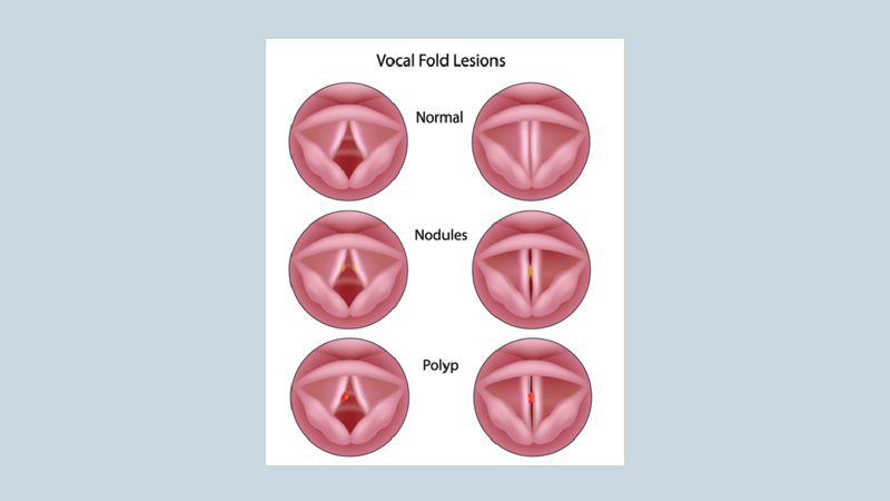 Voice disorders (Change of voice)