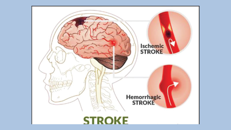 World Stroke Day