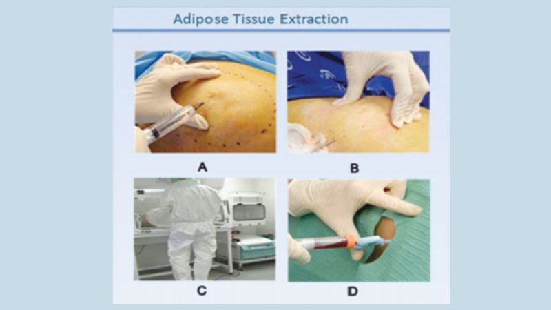 Stem cell therapy for knee injuries and arthritis