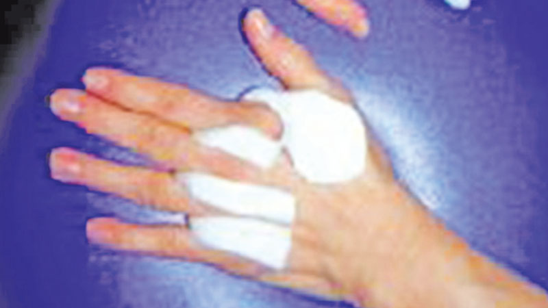 Splint for burn patient