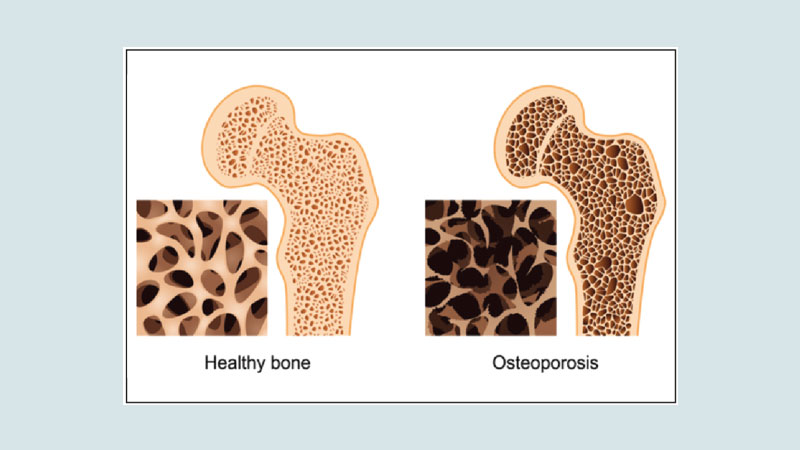 Osteoporosis: Is not a calcium deficiency disease