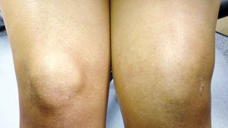 Critical clues on cartilage