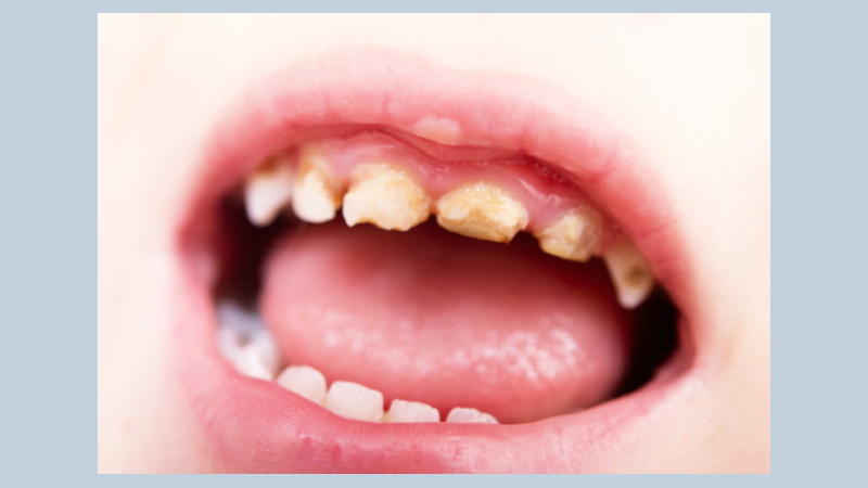 What are the most common dental problems?