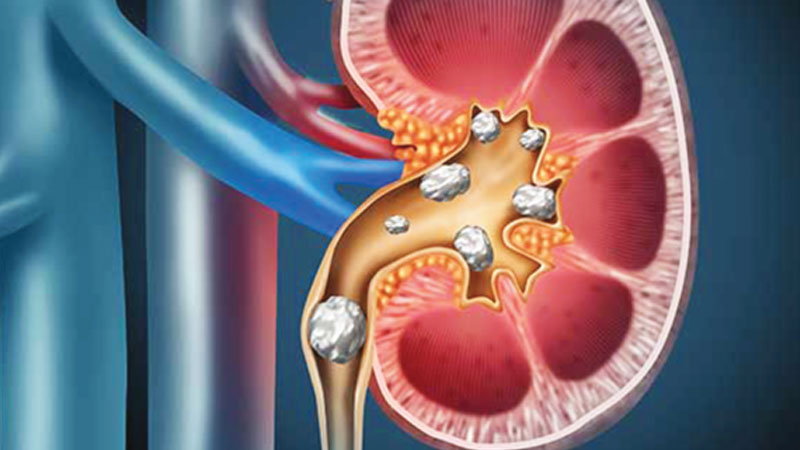 What causes kidney stones?