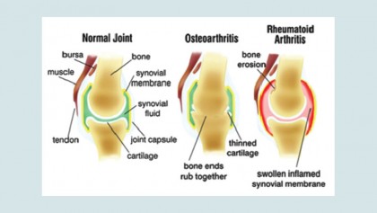 Beating arthritis pain