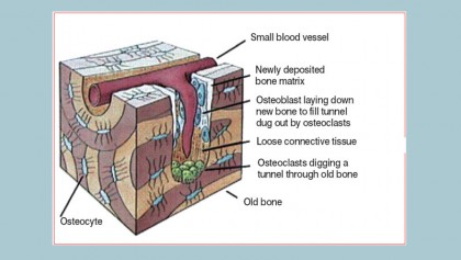 Bone fractures