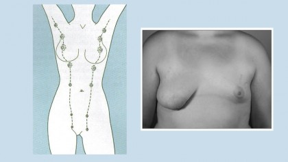 Breast anomalies –an experience