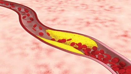 Cardiovascular risk falls in patients with rheumatoid arthritis