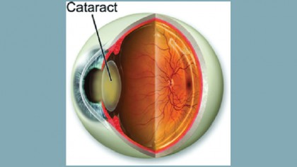 Cataracts