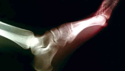 Certain diabetes 
medicines may 
lower gout risk
