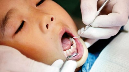 More low-income kids need dental sealants: CDC
