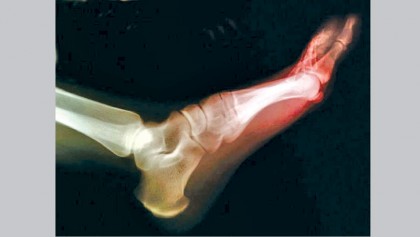 Eat this diet to 
lower your odds 
for painful gout