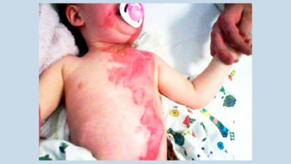 Emergency care of the burn patient