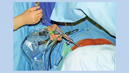 Endoscopic discectomy managing chronic back pain by minimally invasive spine surgery