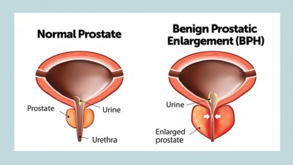 Enlarged prostate gland