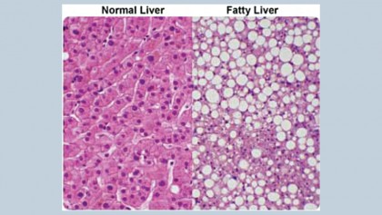 FAQ on fatty liver (Hepatic Steatosis)