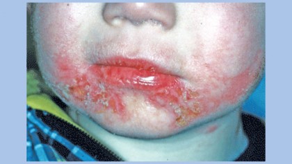 FAQ on streptococcal infections