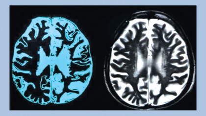 First drug that can slow Alzheimer's dementia