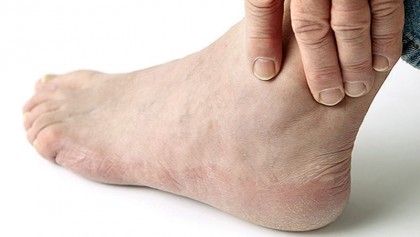Cold-weather foot care for diabetics