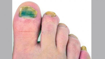 Foot fungus on the run … but  race has a long way to go
