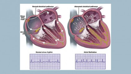 Atrial fibrillation, abnormal heart rhythms and stroke 