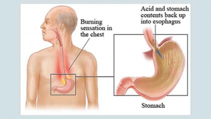 Heartburn (GERD)