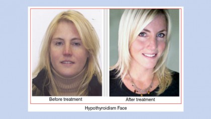 Thyroid fact sheet for women